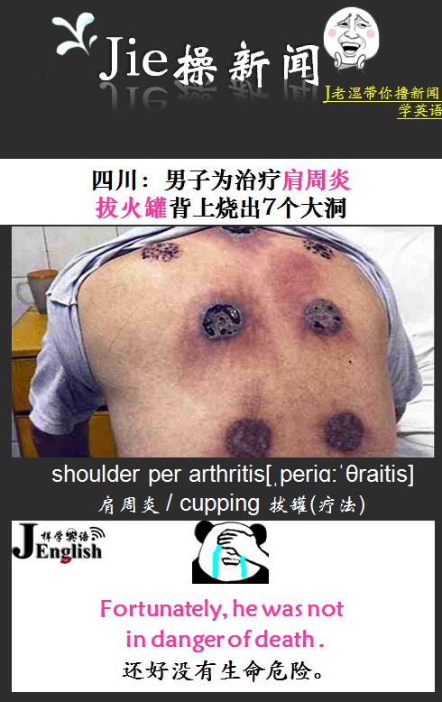 shoulderperarthritis[05periɑ:04θraitis]肩周炎cupping拔罐